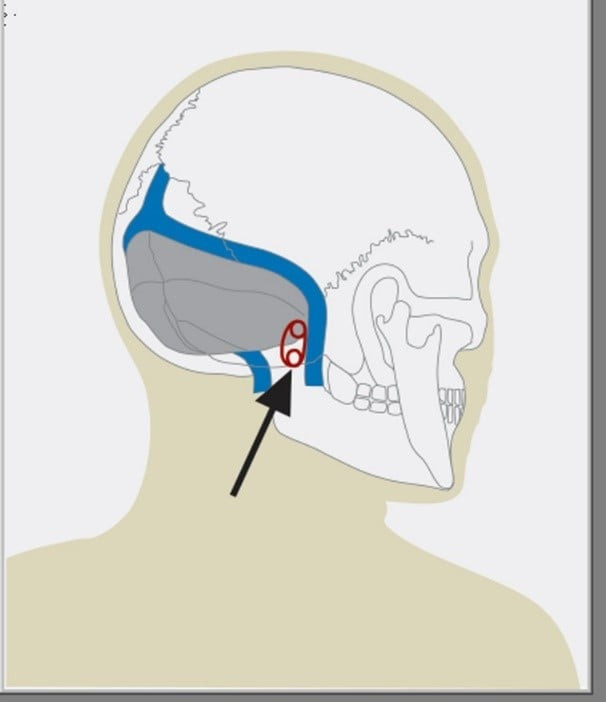 Hình 3: Đường mổ nhỏ sau tai điều trị co giật nửa mặt - Ảnh BSCC