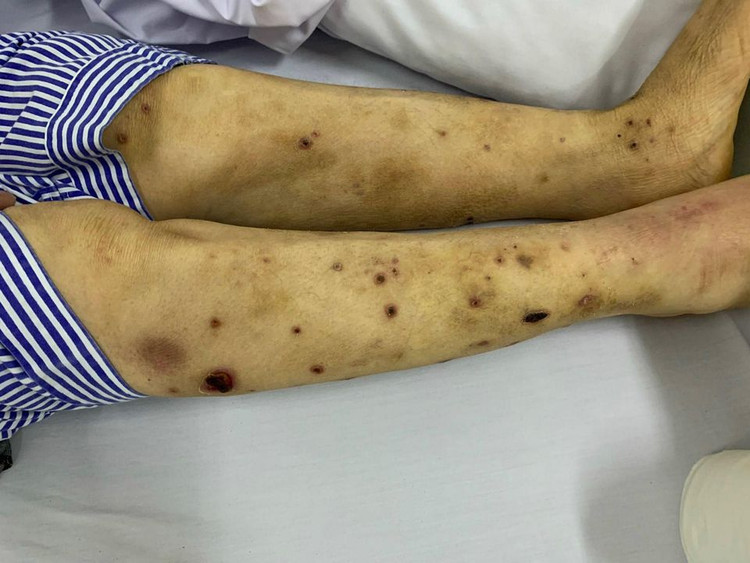 Phù và nhiễm trùng nặng do dùng ong châm chữa bệnh ảnh 1