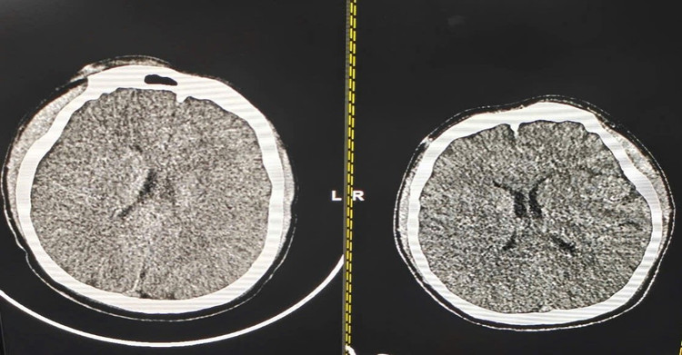 Hình ảnh phim chụp cắt lớp vi tính sọ não của bệnh nhân tại thời điểm nhập viện và sau 5 ngày điều trị tại Khoa Hồi sức nội khoa và chống độc - Ảnh BVCC
