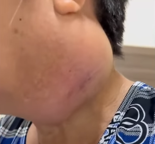 Khối u khủng tồn tại hơn 10 năm trên mặt bệnh nhân - Ảnh BVCC