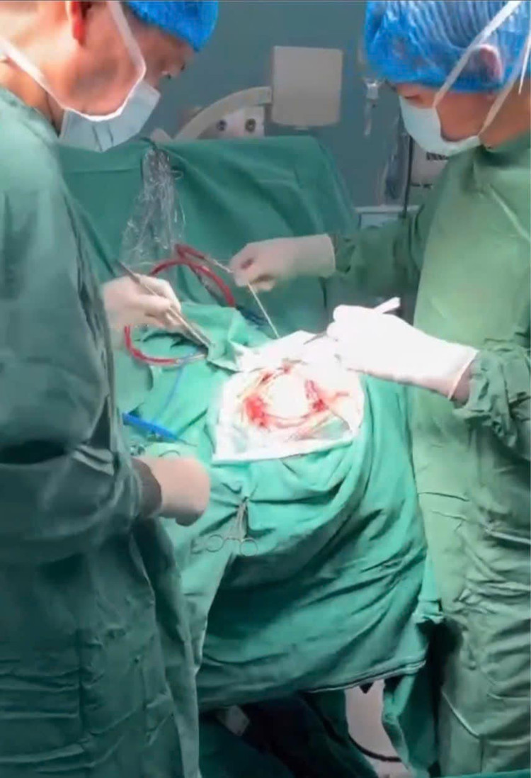 4 giờ đồng hồ căng thẳng phẫu thuật cho bệnh nhân - Ảnh BVCC