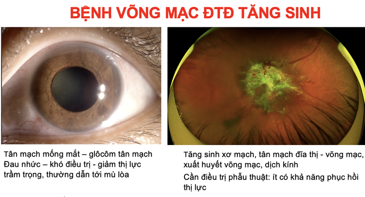 Bệnh võng mạc gây mù lòa ở bệnh nhân đái tháo đường - Ảnh BVCC
