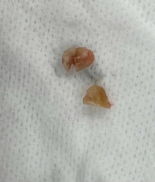 Dị vật hạt đậu phộng được gắp ra - Ảnh BVCC