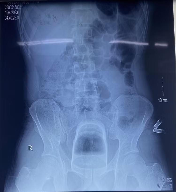 Phim chụp X-quang xác định một chiếc cốc mắc kẹt ở sâu trong trực tràng bệnh nhân