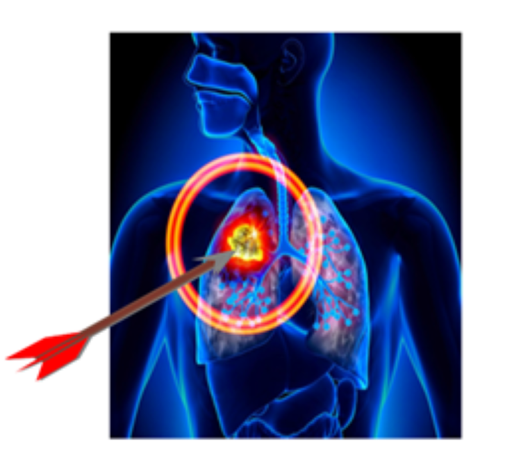 Thuốc đích điều trị ung thư phổi hết đáp ứng, điều trị tiếp thế nào? ảnh 1