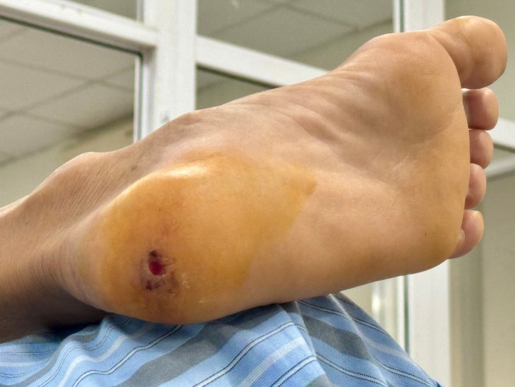 Mắc uốn ván từ vết gai đâm - Ảnh BVCC Mắc uốn ván từ vết gai đâm - Ảnh BVCC