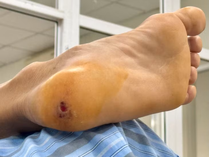 Mắc uốn ván từ vết gai đâm - Ảnh BVCC