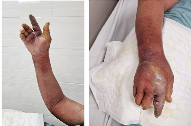 Hình ảnh bệnh nhân bị hoại tử da do viêm mô tế bào - Ảnh minh họa