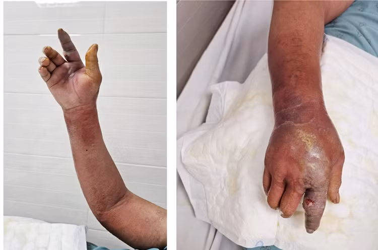 Hình ảnh bệnh nhân bị hoại tử da do viêm mô tế bào - Ảnh minh họa