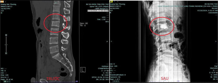 Phim chụp của người bệnh trước và sau điều trị - Ảnh BVCC