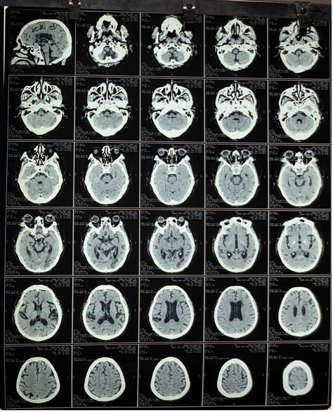 Xuất huyết não do tăng huyết áp cấp