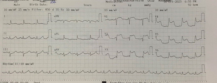 Hình ảnh: Điện tâm đồ của người bệnh khi nhập viện Hữu nghị Việt Tiệp