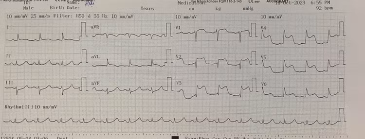 Hình ảnh: Điện tâm đồ của người bệnh khi nhập viện Hữu nghị Việt Tiệp