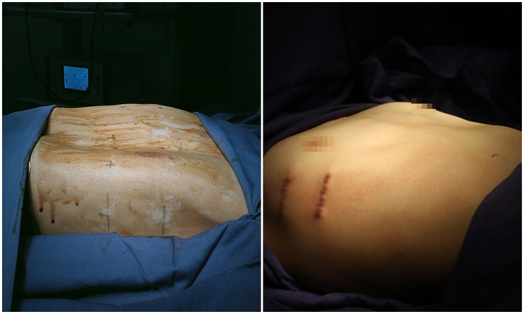 Vùng ngực lõm của bệnh nhân (bên trái) được nâng lên tròn đầy sau phẫu thuật (bên trái).