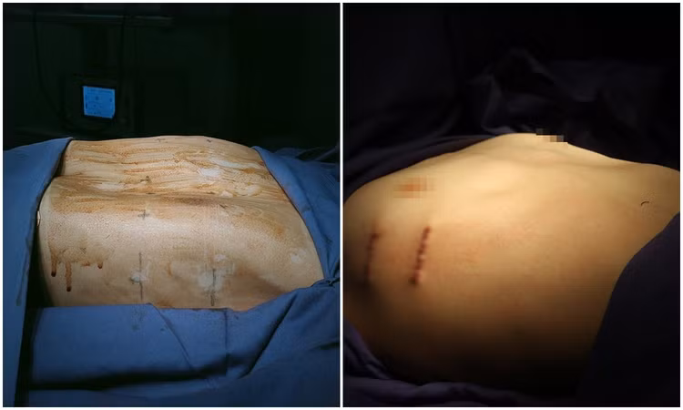 Vùng ngực lõm của bệnh nhân (bên trái) được nâng lên tròn đầy sau phẫu thuật (bên trái). Vùng ngực lõm của bệnh nhân (bên trái) được nâng lên tròn đầy sau phẫu thuật (bên trái).