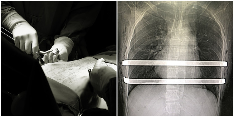 Bệnh nhân U. được đặt 2 thanh nâng kim loại để xử trí vùng ngực lõm - Ảnh BVCC
