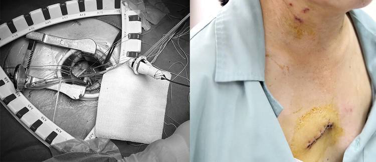 Phẫu thuật nội soi thay van động mạch chủ với vết mổ nhỏ khoảng 4cm - Ảnh BSCC