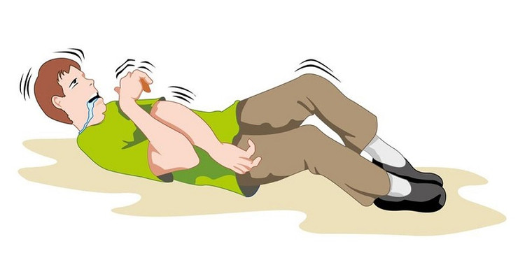 Cơn động kinh - Ảnh BSCC