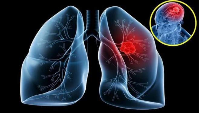 40-50% di căn não xuất phát từ ung thư phổi