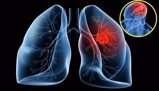 40-50% di căn não xuất phát từ ung thư phổi