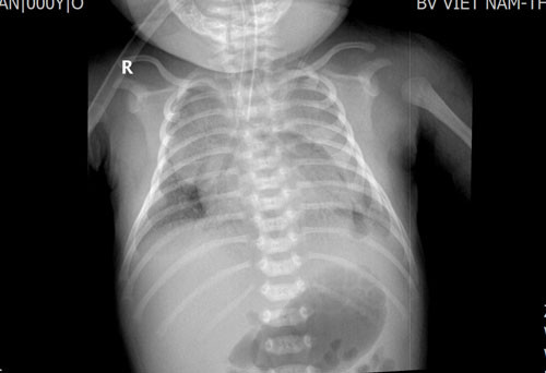Trẻ được chụp X-quang vào ngày điều trị thứ 2 cho thấy phổi mờ đều 2 bên