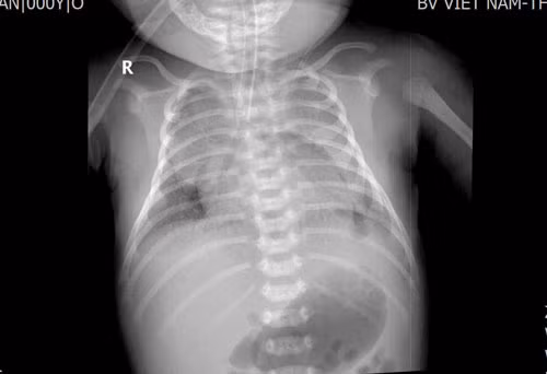 Trẻ được chụp X-quang vào ngày điều trị thứ 2 cho thấy phổi mờ đều 2 bên