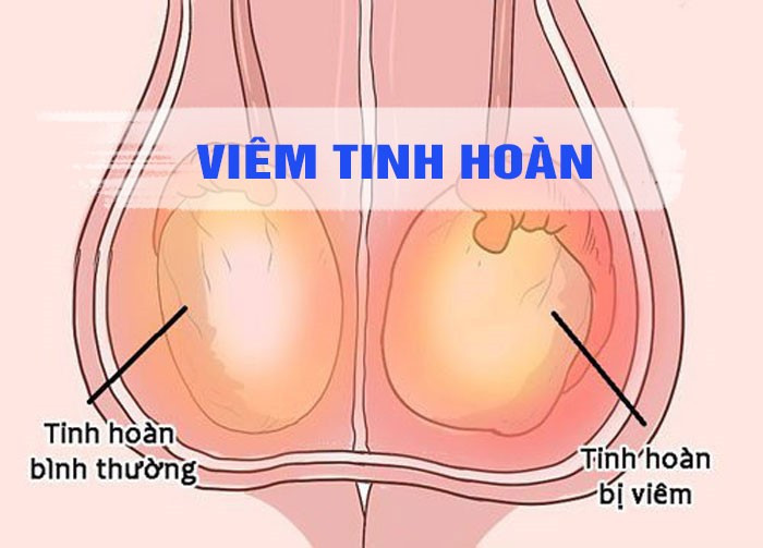 Dễ vô sinh vì viêm tinh hoàn: Cần phát hiện sớm? ảnh 1