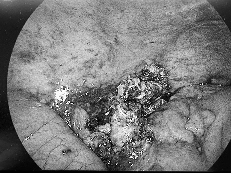 Tình trạng khối áp-xe nhiều mủ trắng đục của bệnh nhân H. Tình trạng khối áp-xe nhiều mủ trắng đục của bệnh nhân H.