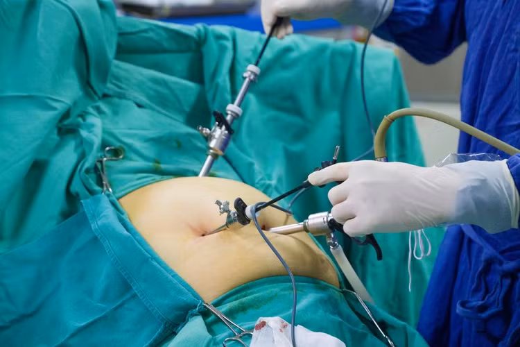 Đau bụng, rối loạn tiêu hóa không ngờ phải cắt túi mật vì u cơ Đau bụng, rối loạn tiêu hóa không ngờ phải cắt túi mật vì u cơ