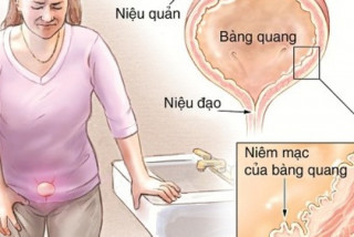 Viêm bàng quang dễ hỏng thận không thể phục hồi