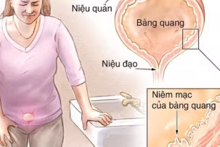 Viêm bàng quang dễ hỏng thận không thể phục hồi