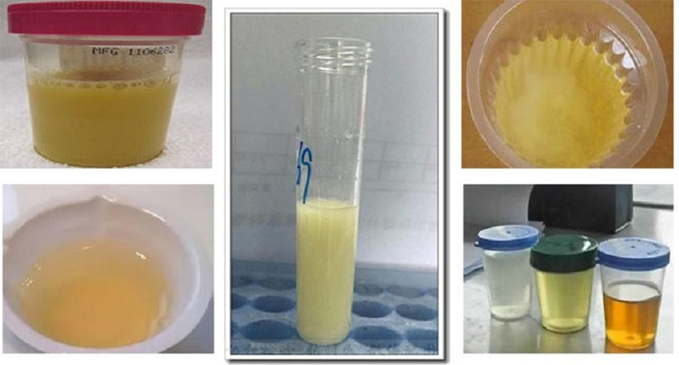 Đái buốt ra mủ