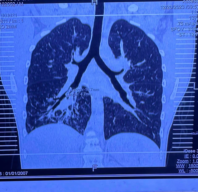 Lấy chiếc kèn bị "bỏ quên" trong phổi thiếu niên suốt 7 năm ảnh 3