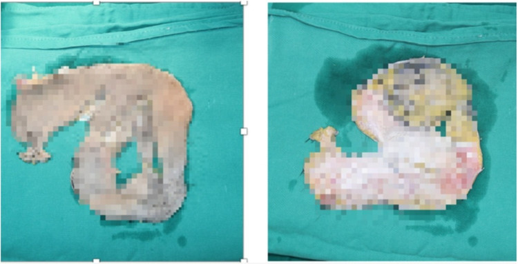 Mảng da đầu của bệnh nhân bị máy khoan cuốn lột thành 2 mảnh