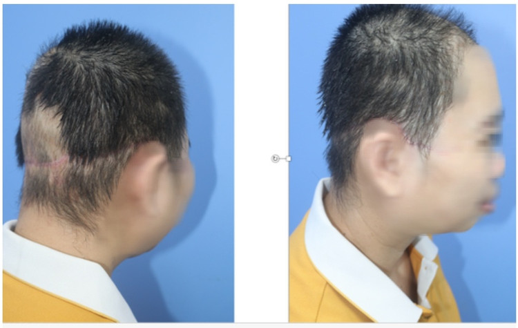 Tóc đã mọc lại sau 3 tháng được nối