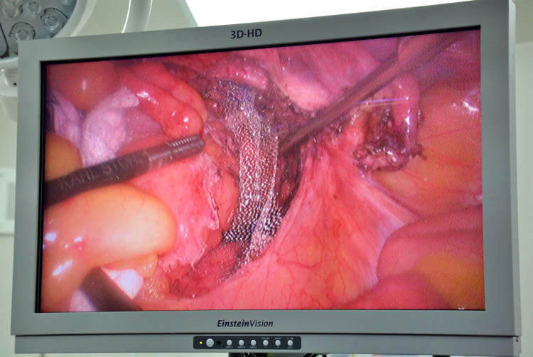 Hình ảnh nội soi đặt lưới nâng trực tràng bị sa