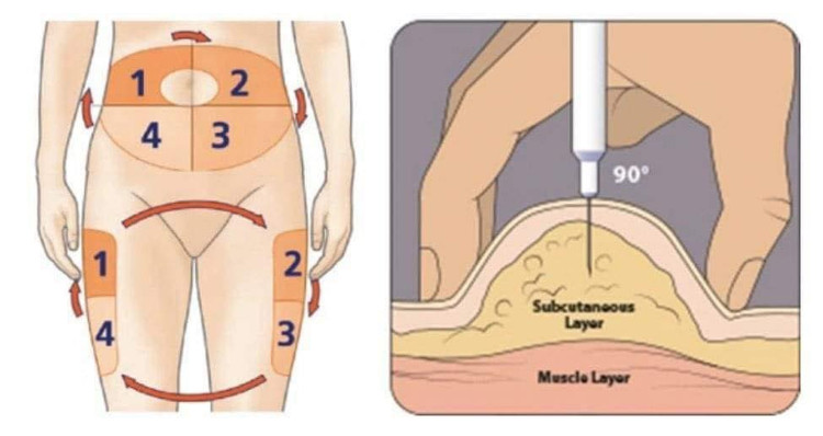 Các vị trí tiêm insulin - Ảnh minh họa