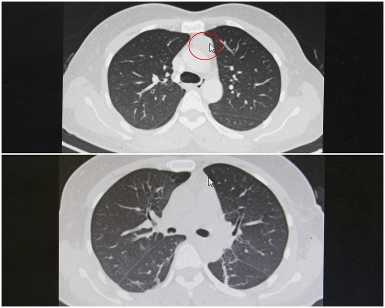 Hình ảnh chụp cắt lớp lồng ngực khối u tuyến ức trước và sau phẫu thuật lấy u