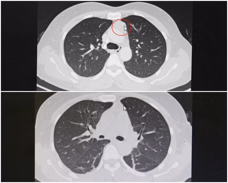 Hình ảnh chụp cắt lớp lồng ngực khối u tuyến ức trước và sau phẫu thuật lấy u Hình ảnh chụp cắt lớp lồng ngực khối u tuyến ức trước và sau phẫu thuật lấy u