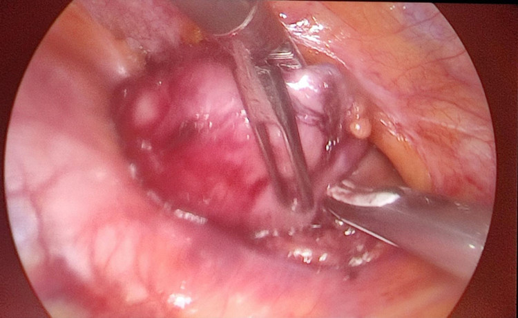 Hình ảnh khối u tuyến ức qua nội soi được kíp phẫu thuật bóc tách - ảnh BSCC