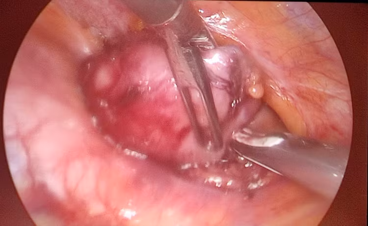 Hình ảnh khối u tuyến ức qua nội soi được kíp phẫu thuật bóc tách - ảnh BSCC Hình ảnh khối u tuyến ức qua nội soi được kíp phẫu thuật bóc tách - ảnh BSCC