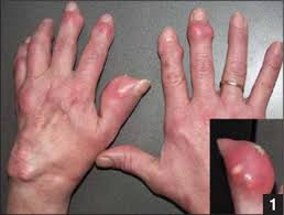 Sưng đau các khớp và nổi hạt tophi do gút