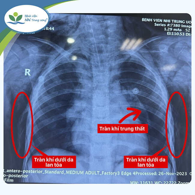 Hình ảnh phim chụp X-quang cho thấy trẻ bị tràn khí màng phổi 2 bên, tràn khí trung thất