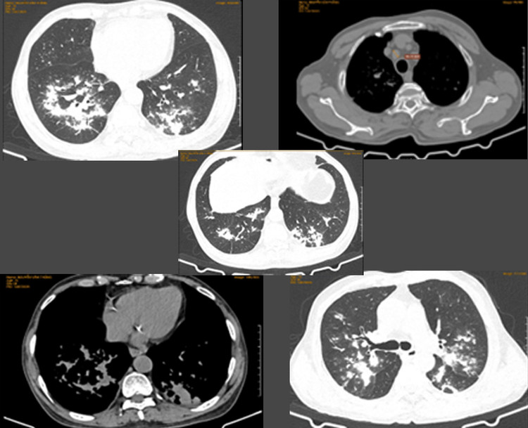 Tổn thương phổi do NTM của bệnh nhân tại Bệnh viện Đa khoa Medlatec Hà Nội.