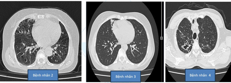 Hình ảnh tổn thương phổi do NTM của các bệnh nhân tại Bệnh viện Đa khoa Hùng Vương (Phú Thọ).