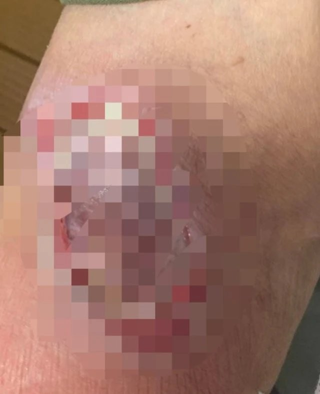 Hình ảnh vết thương vùng khuỷu tay phải