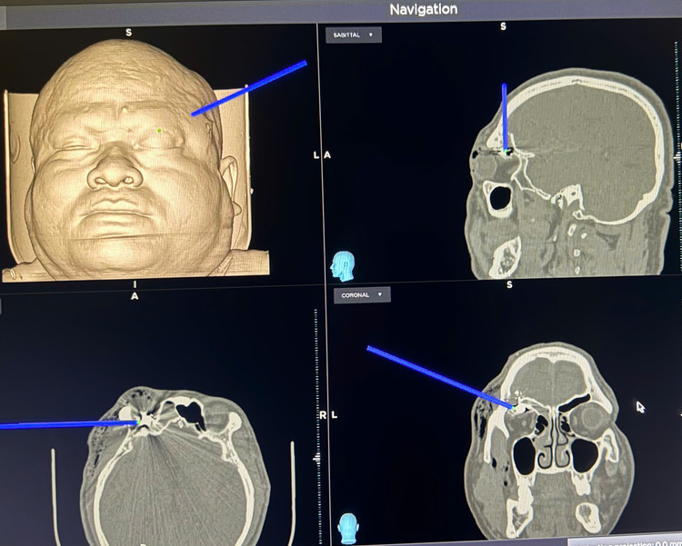 Viên đạn nằm sâu trong hộp sọ trên phim chụp - Ảnh BVCC