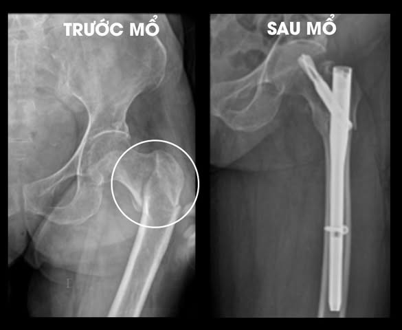 Hình ảnh gãy xương trước và sau điều trị - Ảnh BVCC