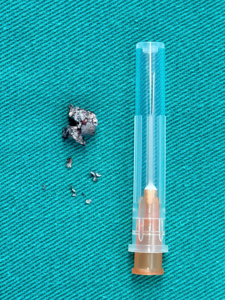 Các bác sĩ đã tiến hành lấy dị vật cho bệnh nhân - Ảnh BVCC