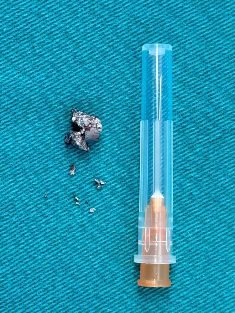 Các bác sĩ đã tiến hành lấy dị vật cho bệnh nhân - Ảnh BVCC